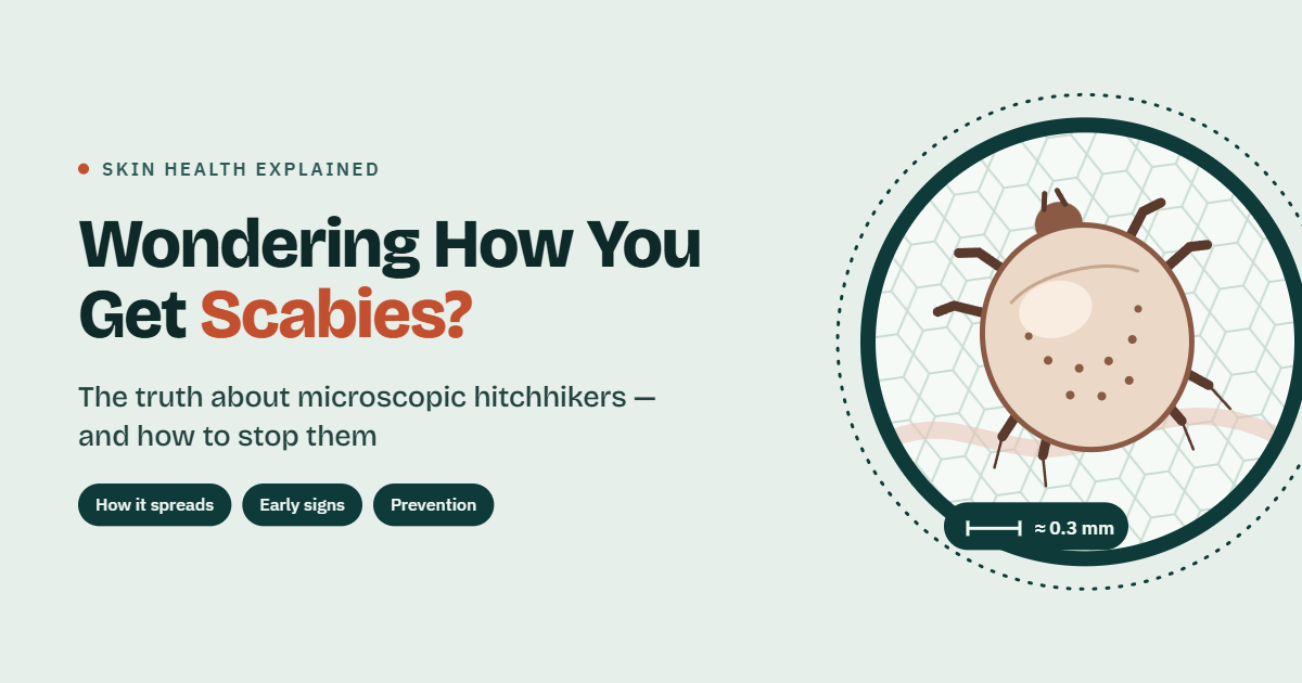 Wondering How to U Get Scabies? the Truth about Microscopic Hitchhikers and How to Stop Them